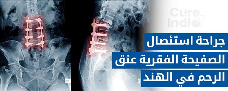 استئصال الصفيحة العنقية